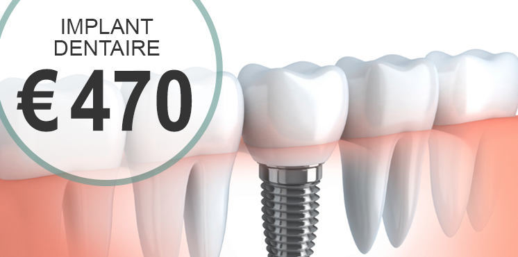 Implant Dentaire